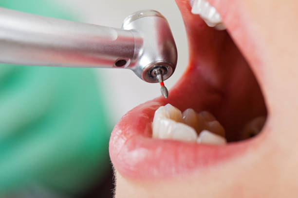 Best Emergency Treatment for Dental Infections or Abscesses in Madison, GA